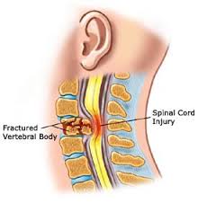 Spinal cord defects