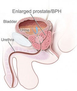 Benign Prostate Hyperplasia