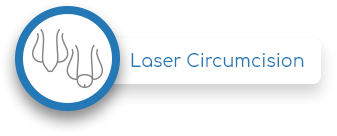 Laser circumcision