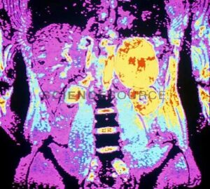 kidney cancer