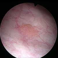 Urinary Bladder Cancer