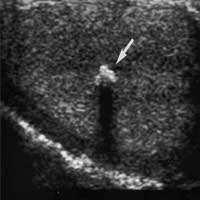 Testicular Cancer
