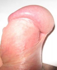 short frenulum