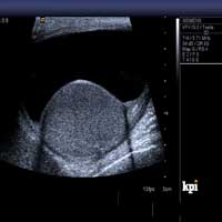 Hydrocele